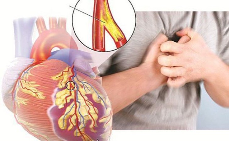 Liệu pháp ức chế đồng vận chuyển natri-glucose 2 có thể hạn chế tử vong do suy tim