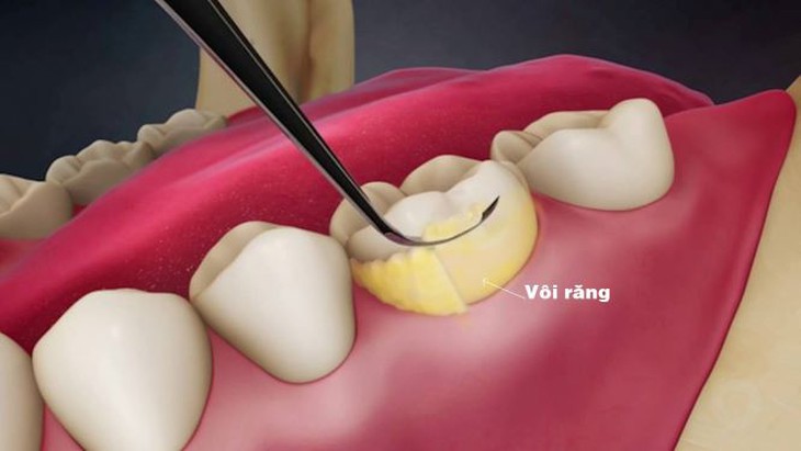 tăng nguy cơ mắc các dạng nặng COVID-19 khi bị viêm nha chu
