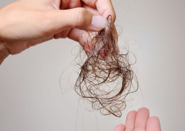 Tình trạng rụng tóc ở bệnh nhân sau xạ trị được cải thiện nhờ minoxidil