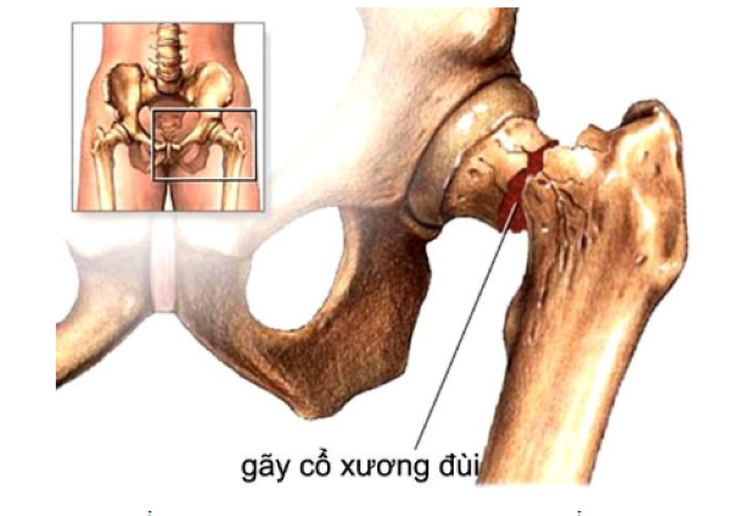 Tỉ lệ gãy xương đùi do bisphosphonate cao nhất ở người châu Á