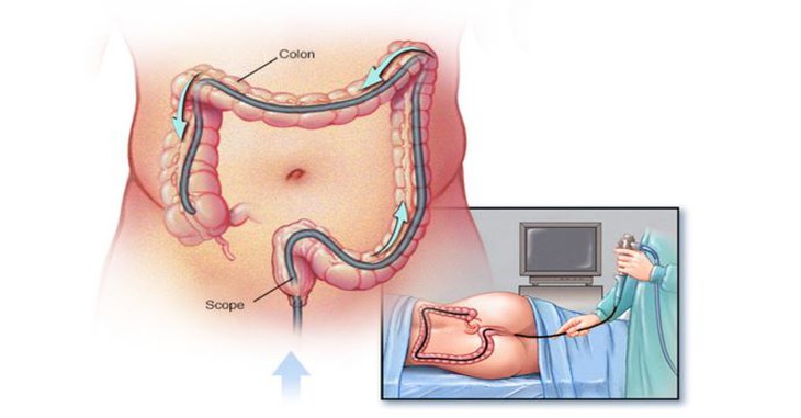 nội soi đường ruột