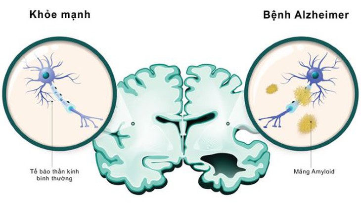 Nghiên cứu vắc-xin chống lại bệnh Alzheimer