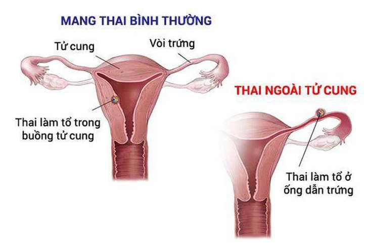 mang-thai-ngoai-tu-cung(1)