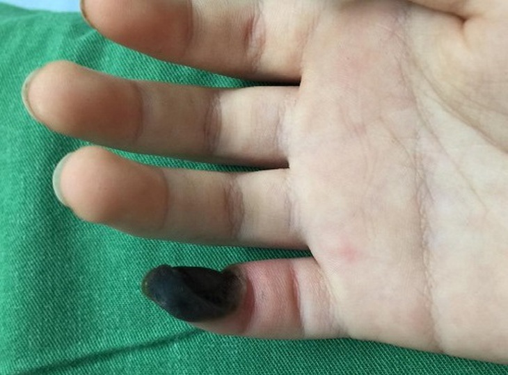 Cha mẹ mua thuốc trên mạng để chữa mụn cóc, bé 9 tuổi hoại tử ngón tay