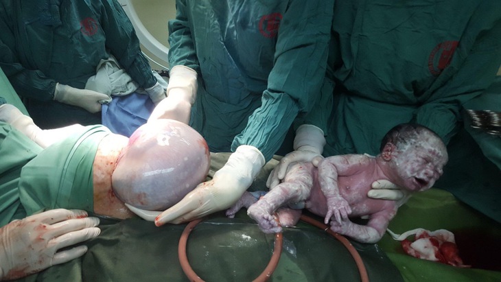 Đặc biệt: Sản phụ sinh đôi 1 em bé  còn trong túi ối!