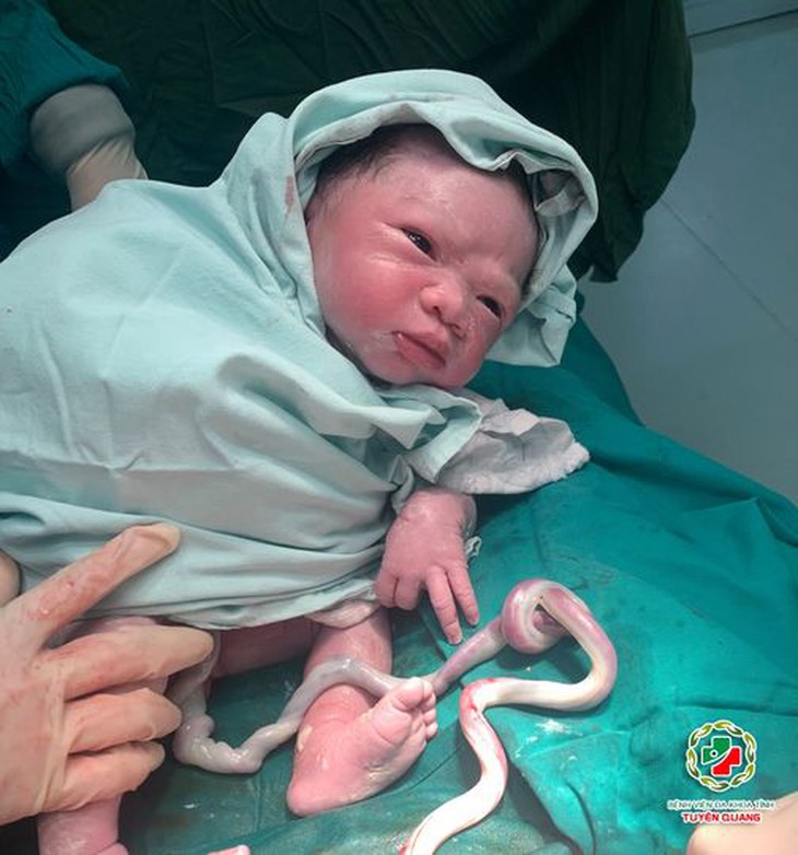 Mổ cấp cứu thai nhi có dây rốn thắt nút 2 vòng