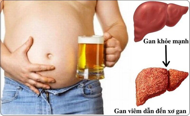 Điều cần biết về bệnh viêm gan do rượu