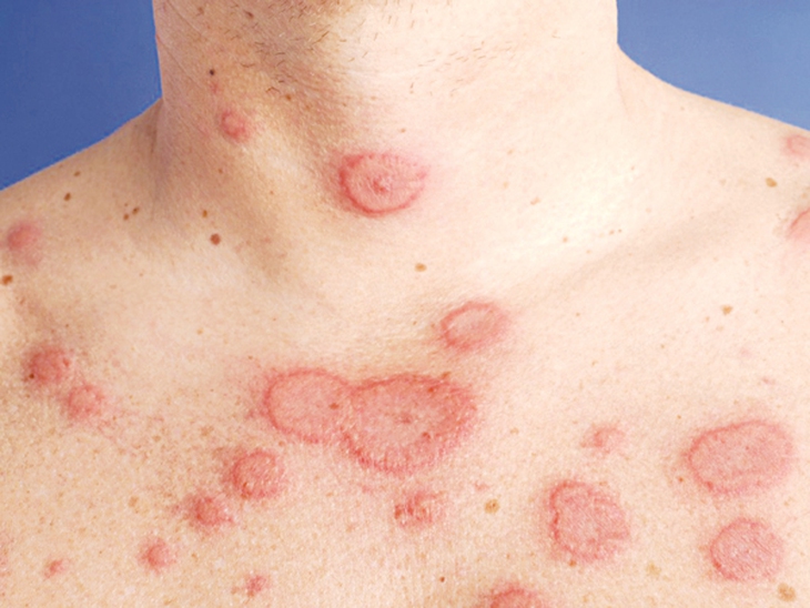 lupus ban do
