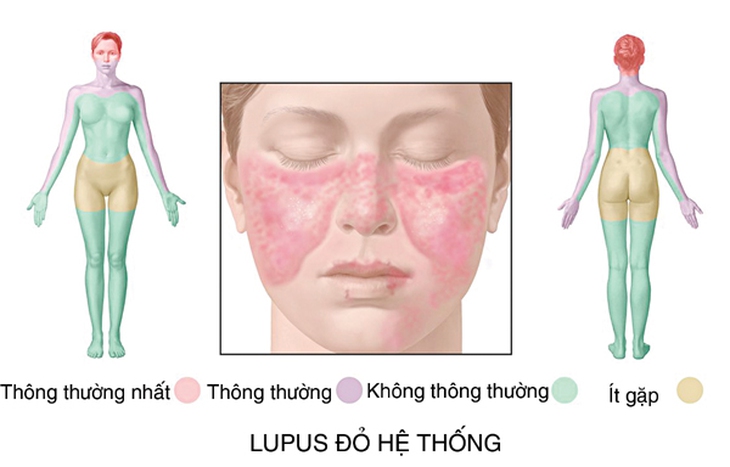 lupus ban do
