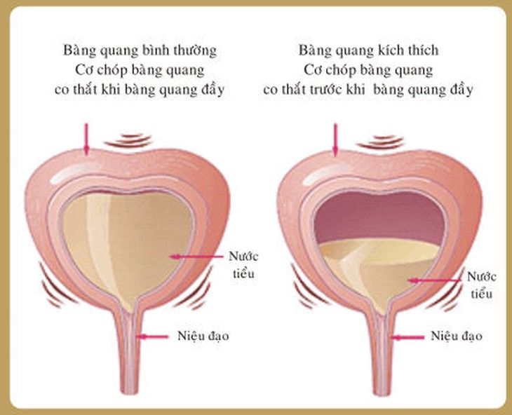viem bang quang 