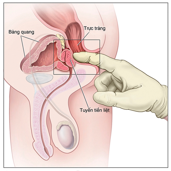 u xơ tuyen tien liet