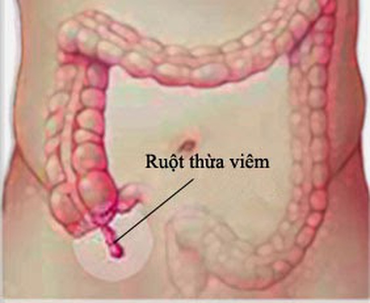 viem  ruot thua