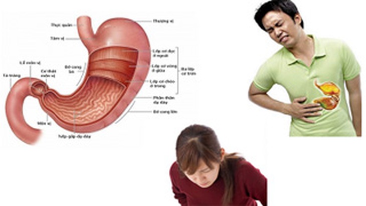 Khắc phục chứng đau dạ dày không loét 