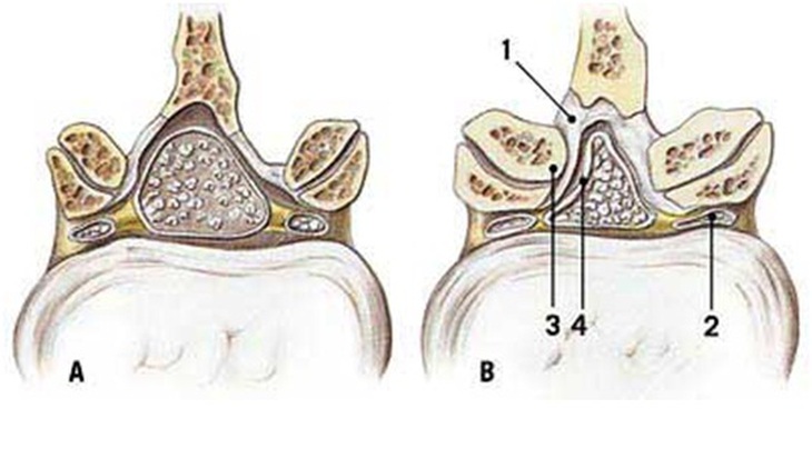 Hẹp ống sống - Những biến chứng nguy hiểm