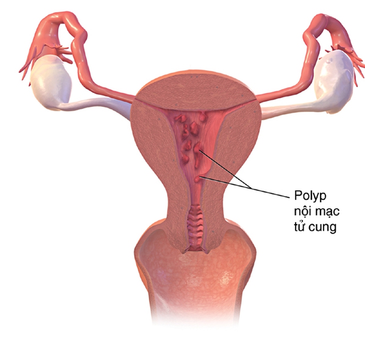 Xuất huyết tử cung bất thường