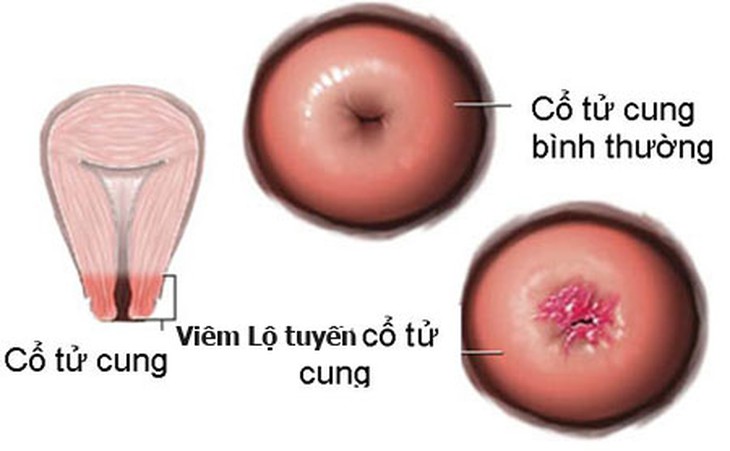 Bệnh ở tử cung