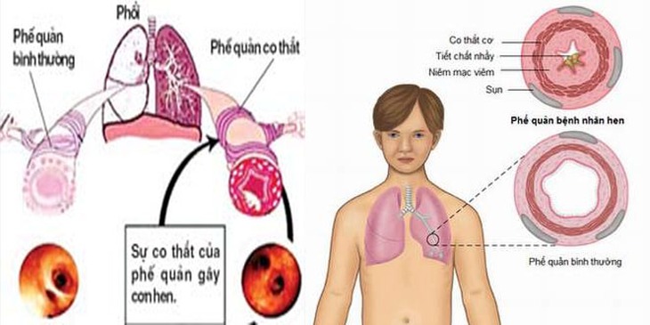 giãn phế quản