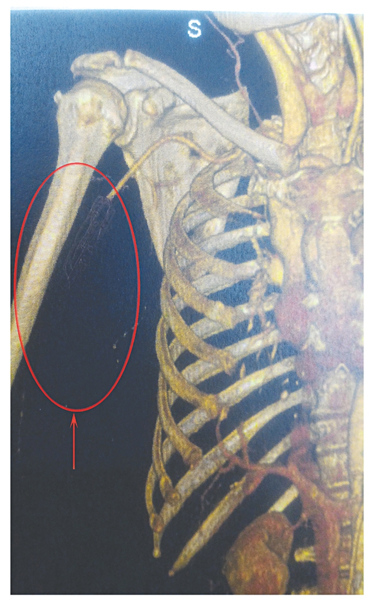 Nhầm lẫn giữa đau xương khớp và tắc động mạch có thể dẫn đến hoại tử chi