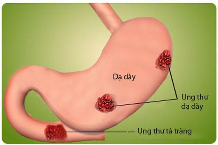Dưa muối: Lợi, hại thế nào?