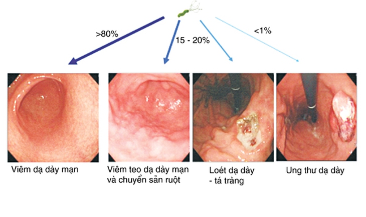 Viêm dạ dày - tá tràng và nhiễm khuẩn Helicobacter pylori