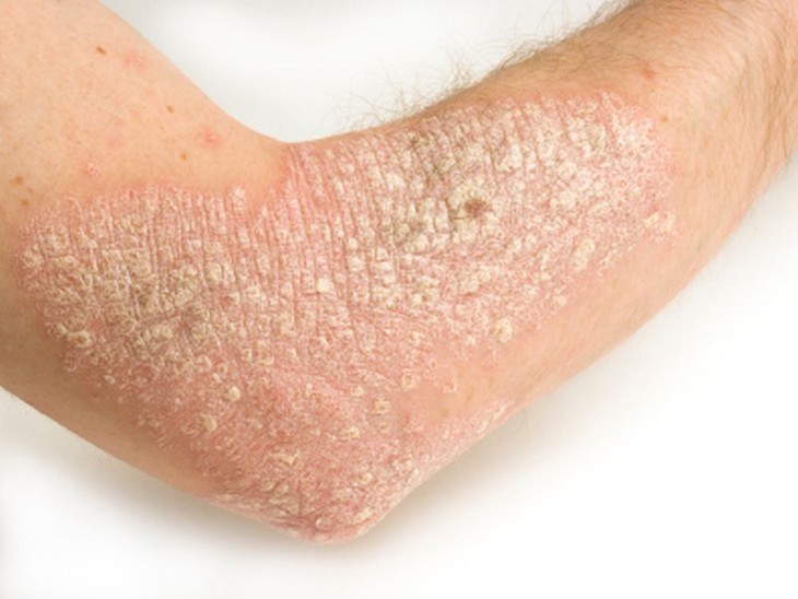 FDA phê chuẩn thuốc điều trị vảy nến dạng tiêm cho những trường hợp khó