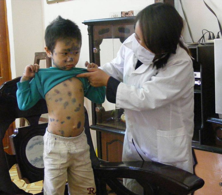 Phòng ngừa biến chứng bệnh thủy đậu