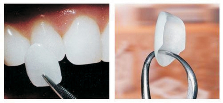 Mặt dán sứ cải thiện màu sắc giúp răng trắng đẹp