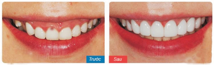 Mặt dán sứ cải thiện màu sắc giúp răng trắng đẹp