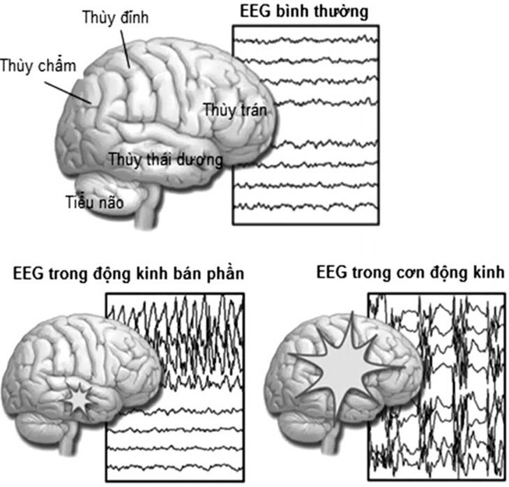 Thuốc chống động kinh và lưu ý đặc biệt khi dùng
