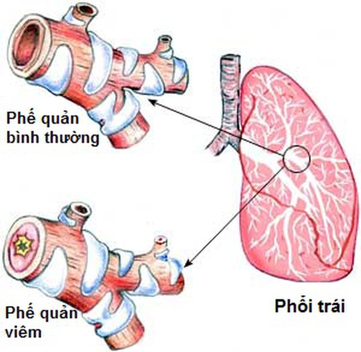 Viêm phế quản cấp