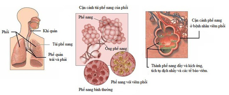  Viêm phổi ở bệnh nhân đái tháo đường