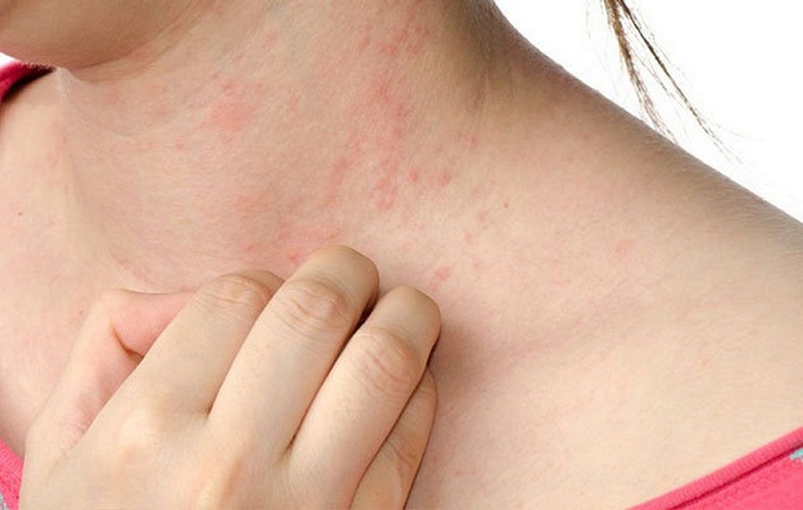 dị ứng thuốc điều trị