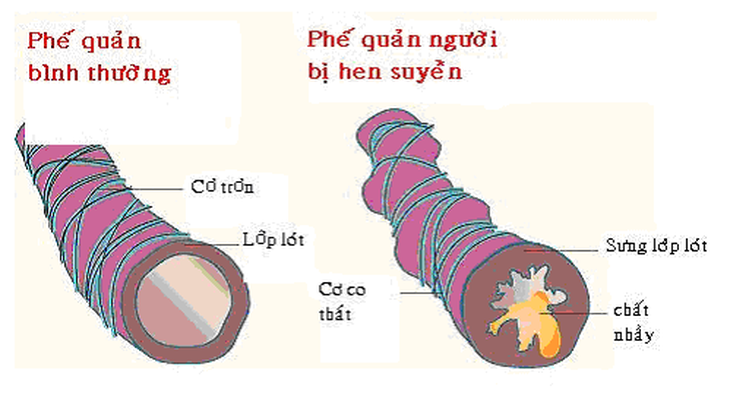 Vì sao khuyến cáo bệnh nhân hen không được dùng?