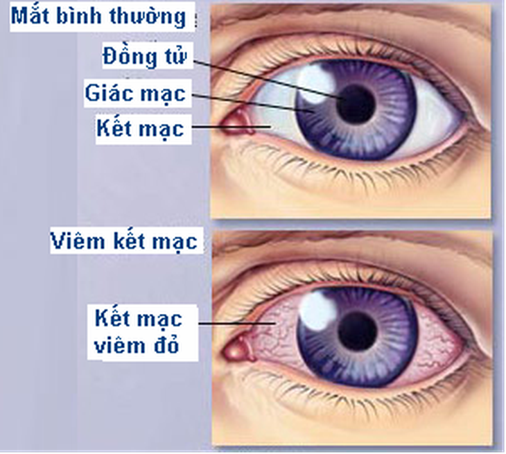 Bài thuốc trị viêm kết mạc