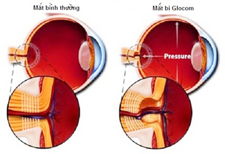 Sử dụng thuốc cho người tăng nhãn áp