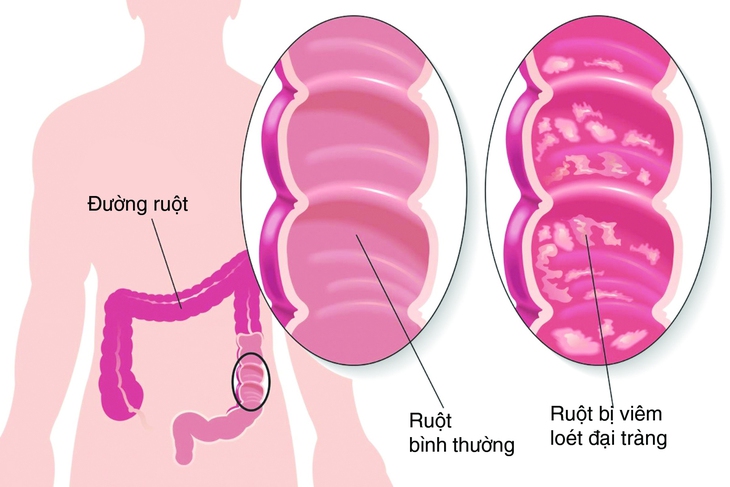 Viêm đại tràng mạn tính