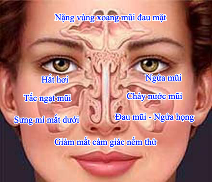 Viêm mũi dị ứng