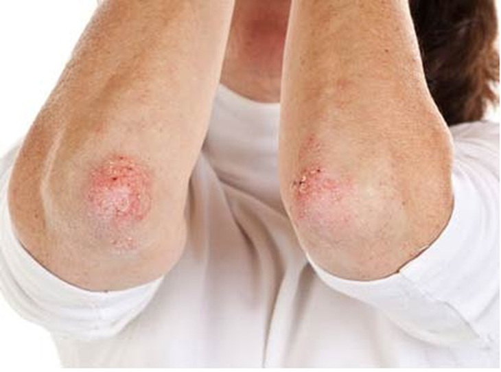 Các bệnh về da thường gặp