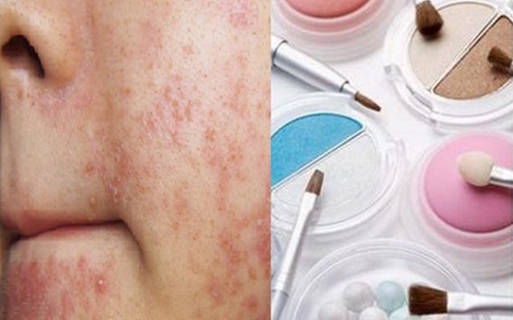  Xử trí dị ứng mỹ phẩm