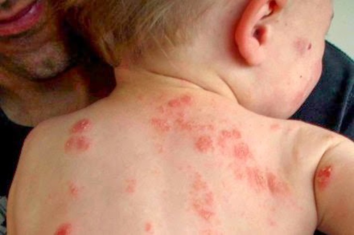  Tìm ra nguyên nhân gây bệnh eczema
