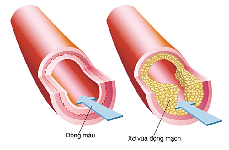 Cách nhìn mới về xơ vữa động mạch