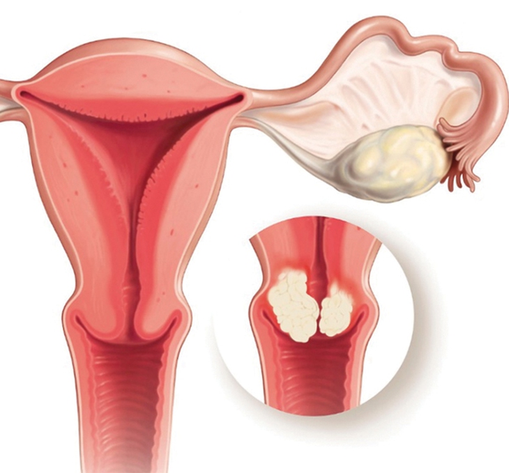 Phòng ngừa ung thư cổ tử cung bằng vắcxin hpv