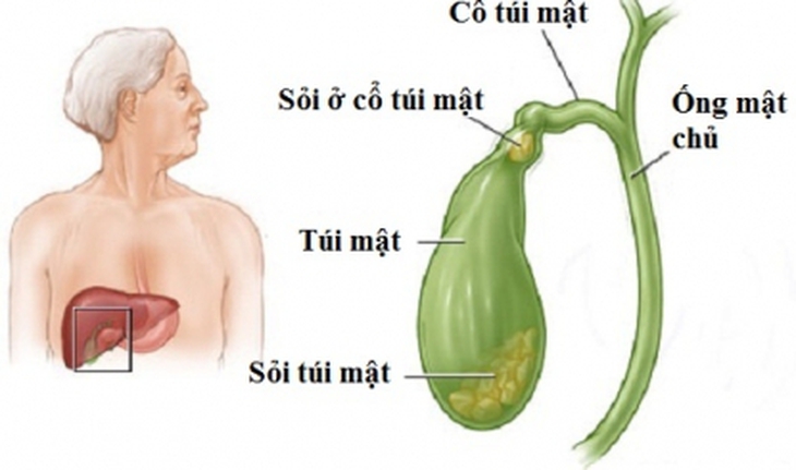 Cách phòng sỏi mật tái phát