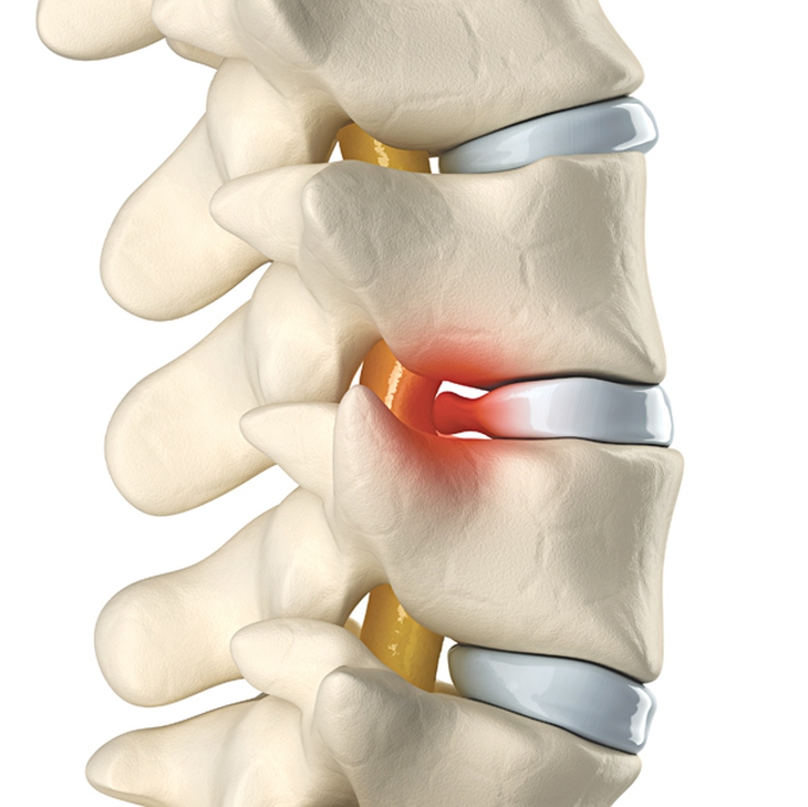 Biến chứng do thoái hóa đốt sống cổ