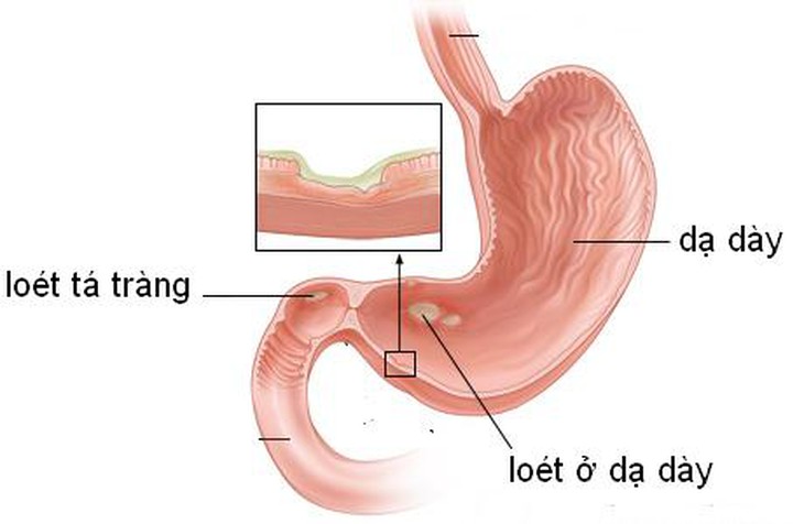 Nguyên nhân loét dạ dày - tá tràng