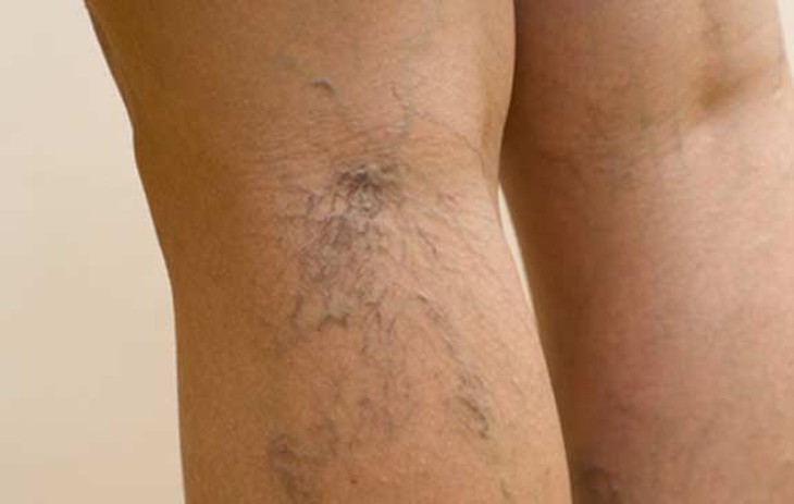 Cách ngăn chặn tĩnh mạch mạng nhện trên da