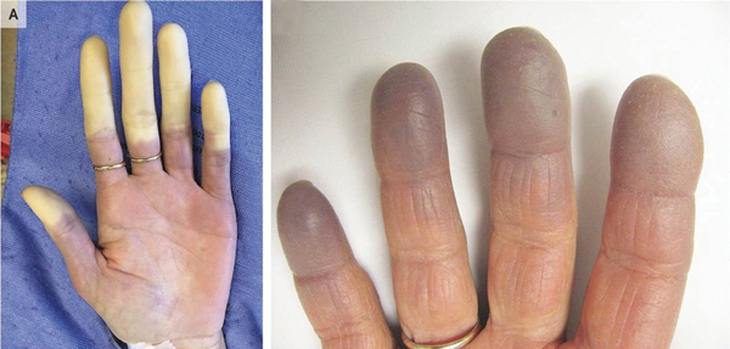 Các thuốc điều trị hội chứng Raynaud