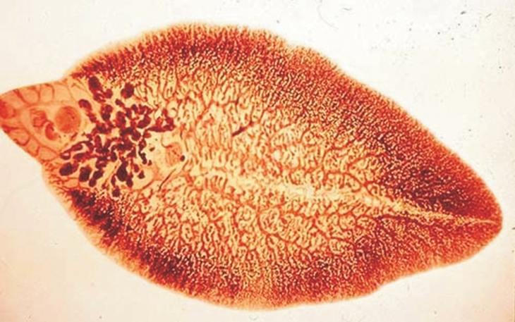 Bệnh sán lá gan lớn