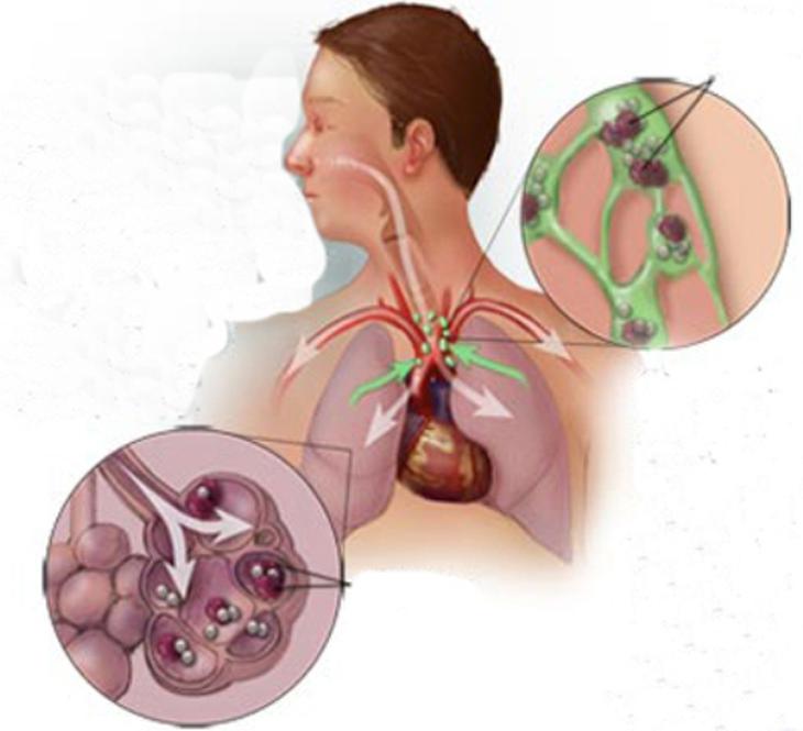 Cảnh giác nhiễm nấm Histoplasmosis