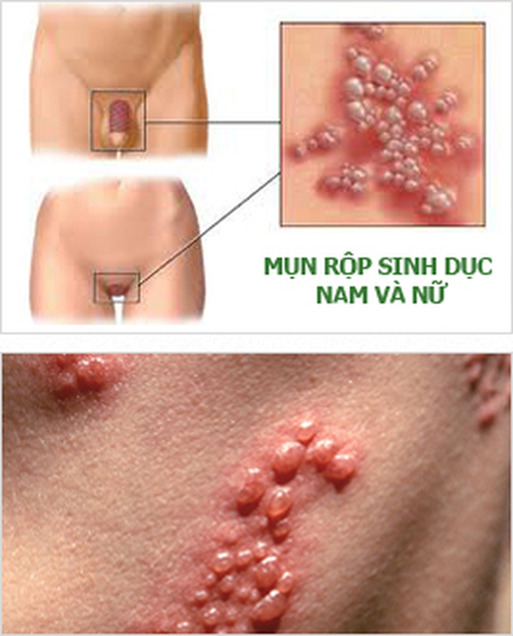Nguy cơ hiếm muộn do bệnh lây truyền qua đường tình dục